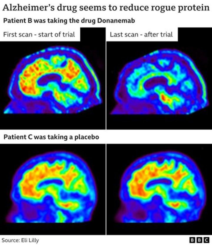 New drug donanemab is 'a turning point in the fight against Alzheimer’s'